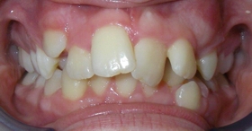Before orthodontic treatment