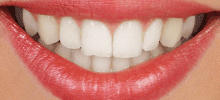 Ceramic braces Mosman Park Orthodontics
