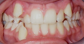 Before orthodontic treatment