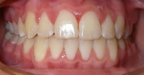 After orthodontic treatment