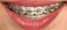 Self-ligating braces Mosman Park Orthodontics